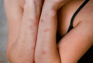 what do bed bug bites look like