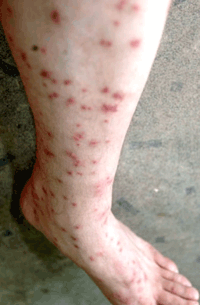 Complications caused by flea bites
